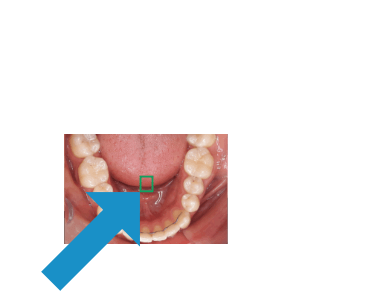 dental-camera-dentaleyepad-animation-compare-camera-screen-lower-jaw