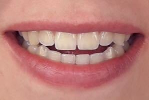 dentaleyepad beispielfoto Lächeln von vorne geöffnet 5
