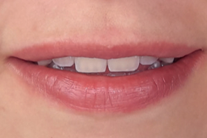 dentaleyepad beispielfoto lächeln von vorne leicht geöffnet 2