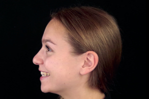 dentaleyepad Beispielfoto Profil von links offenes- ächeln