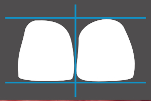 dentaleyepad overlay Oberkiefer Front Detail