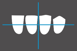 dentaleyepad overlay Unterkiefer schräg rechts